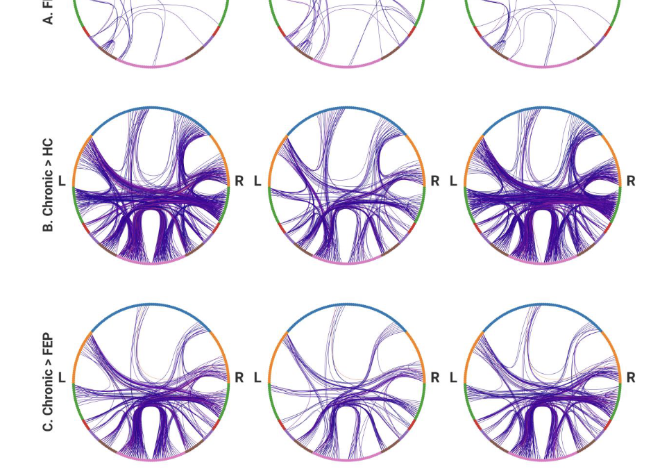 Mostly intact brain structure in early psychosis